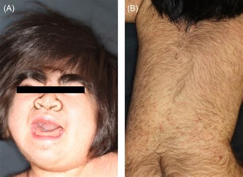 First Japanese Case Of Congenital Generalized Hypertrichosis With A