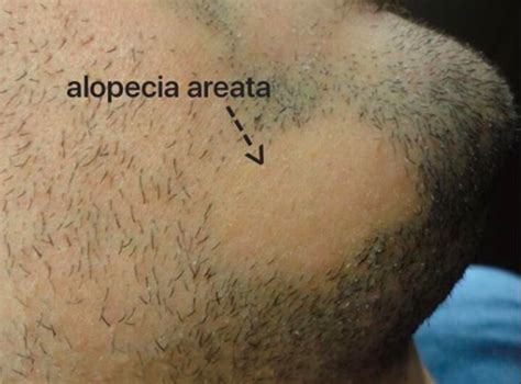 Scalp alopecia in men with beard alopecia: What are the risks ...