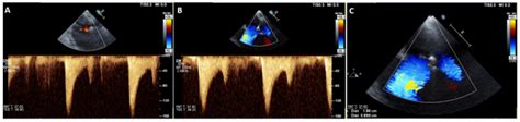 Calculation Of Mitral Valve Area By Continuity Equation Using Velocity