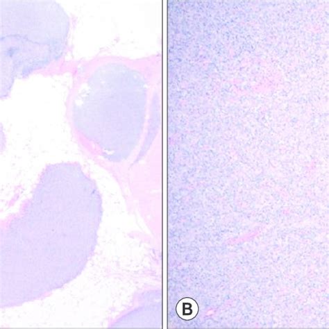 Low Power A Histologic Examination Revealed A Cystic Lesion And