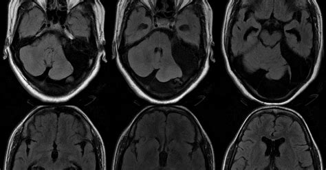 Neuroradiology Cases: Posterior Fossa Arachnoid cyst MRI