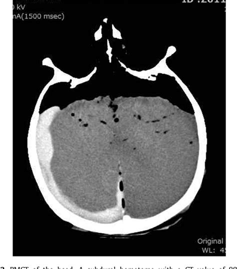 Figure From Use Of Postmortem Computed Tomography To Reveal Acute