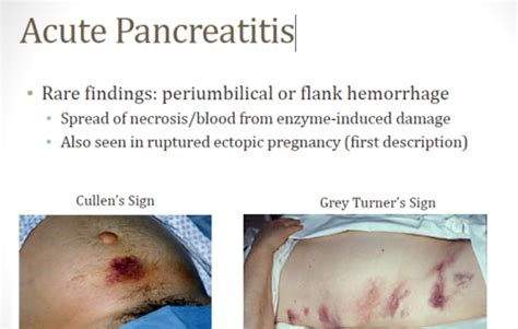 Grey Turner Sign Pancreatitis