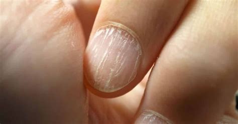 Unhas quebradiças jamais estas 5 soluções caseiras Unhas