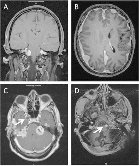 Phenotypes Of NF2 A Bilateral Vestibular Schwannomas B Multiple