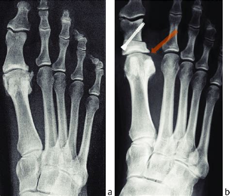 Preoperative A And Postoperative B Weightbearing Ap Radiographs Of