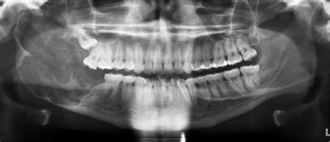 Ameloblastoma X Ray