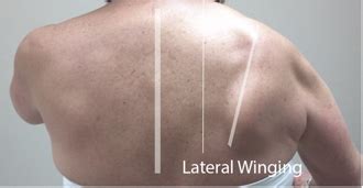 Scapular winging | Sport Med School