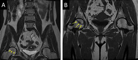 Avascular Necrosis Of Femoral Head Mri