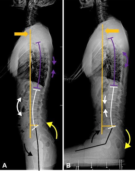 The Normal Spinopelvic Motion From Standing A To Sitting B Position