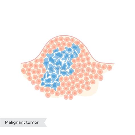 Illustration IsolÃe Du Vecteur De Tumeur Maligne Illustration de