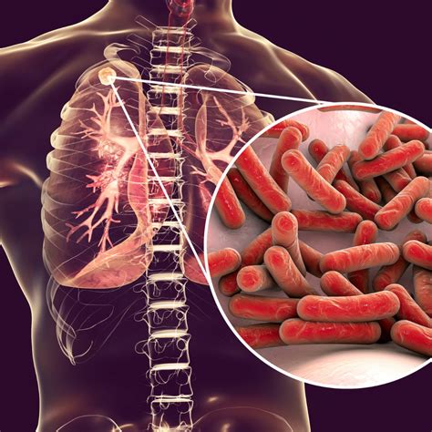 Tuberculosis Testing Shasta County California