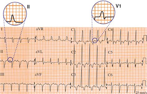 P Cardiale Biatrial Enlargement Ecg Book