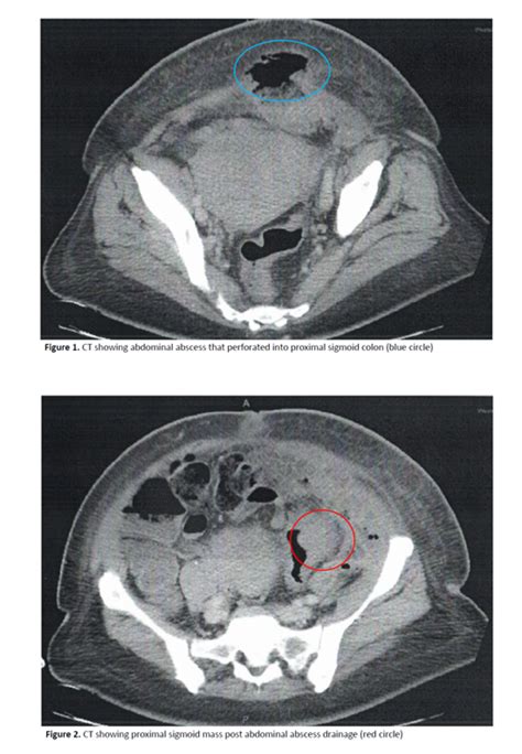 Can Colon Cancer Be Mistaken For Diverticulitis Difference In Clinical Features Between Right