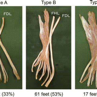 Classification of the connections of the FHL tendon slip to the lesser ...