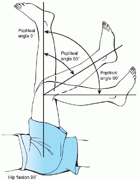 Cerebral Palsy Teachme Orthopedics