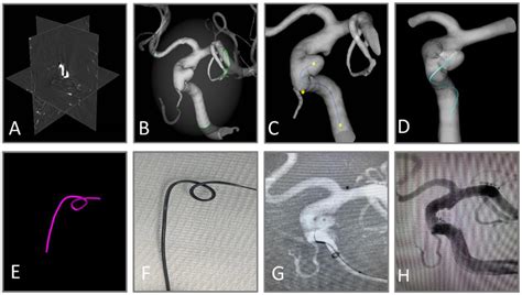 Workflow Of Virtual Shaping Of Microcatheter With Aneushape A