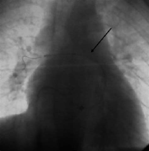 Aspirex device placed on the right pulmonary artery. | Download ...