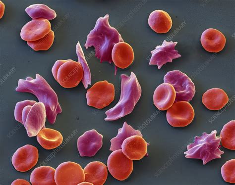 Sickle Cell Anaemia Sem Stock Image C058 0927 Science Photo Library