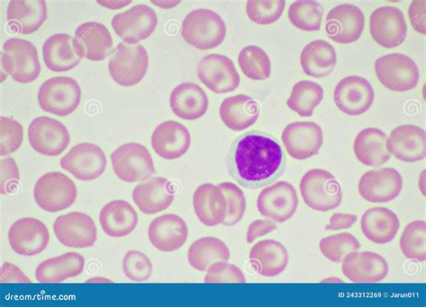 Target Cells with Abnormal Red Blood Cells in Blood Smear Stock Image ...