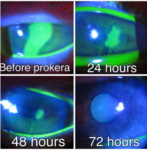 Prokera Amniotic Membrane | The Contact Lens Institute of Nevada