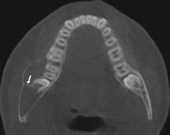 Unusual Cone Beam Computerized Tomography Presentation Of Traumatic