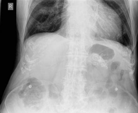 splenic arterial calcification radiology case radiopaediaorg
