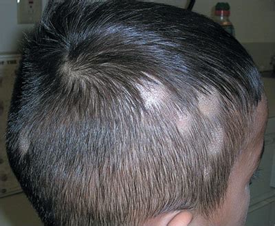 Hair loss on scalp | MDedge Family Medicine