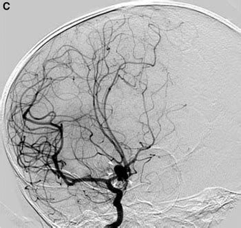 Brain Aneurysm: Symptoms & Causes | Study.com