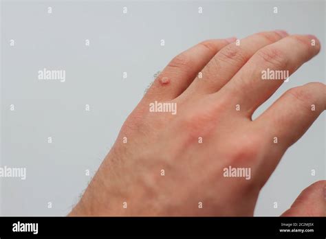 Wart On Hand Finger Isolated On White Background Stock Photo Alamy