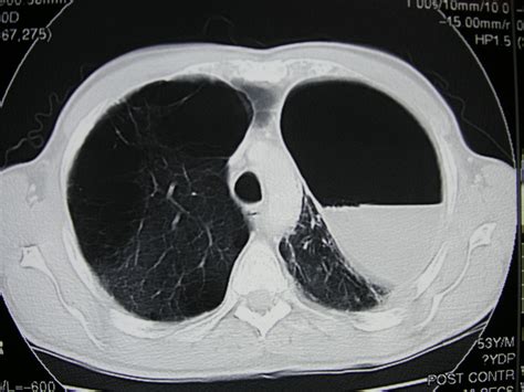 Infected Bulla Of Lung Eurorad