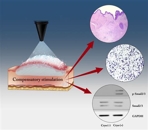 IJMS Free Full Text Could 79 C Spray Type Cryotherapy Be An