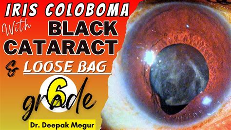 Iris Coloboma With Cataracta Nigra And A Loose Bag Grade 6 Dr