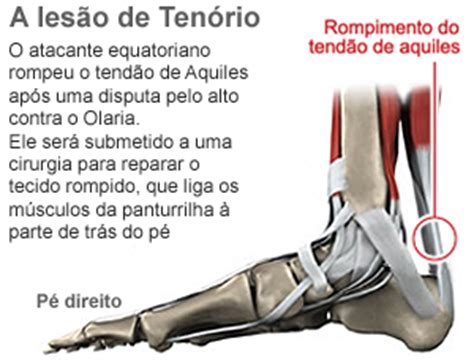 ruptura do tendão de Aquiles Tenório para por seis meses