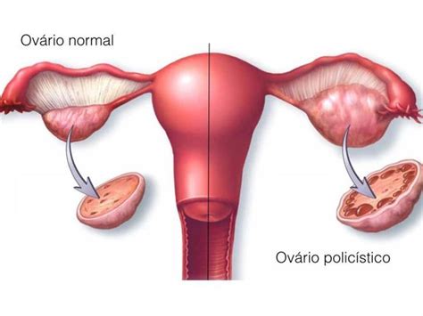 Ov Rio Polic Stico Sintomas Tratamento E Riscos Na Gravidez