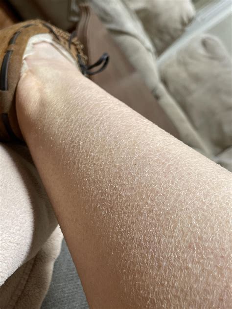 [skin Concern] Chronic Scaley Flakey Dry Skin On Legs R