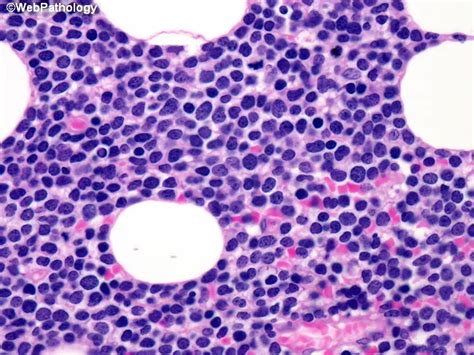 Mantle Cell Lymphoma Lymph Node