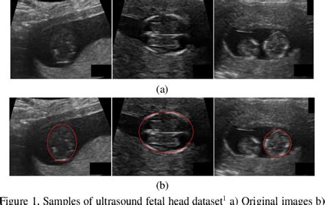 Fetal Ultrasound Image Segmentation For Measuring Biometric Parameters Using Multi Task Deep