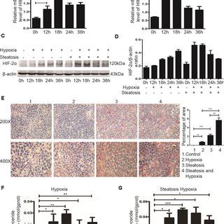 HIF 2α induces steatotic HCC lipid synthesis under a hypoxic