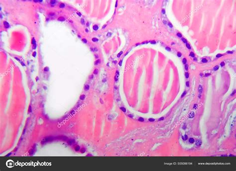 Follicular Adenoma Thyroid Gland Light Micrograph Histopathology