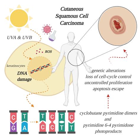 Squamous Cell Carcinoma Diagram