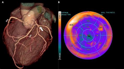 A Cardiac Computed Tomography Angiography Demonstrated An Anomalous