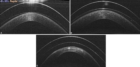 Rigid Scleral And Corneoscleral Lens Design And Fitting Clinical Tree