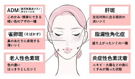 シミを消す方法は美容クリニックの治療がおすすめ。医師がシミの種類別治療法を徹底解説。 麻布十番の皮膚科・美容皮膚科ならmbc・麻布十番