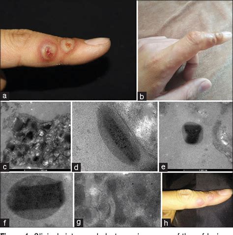 Figure 1 From A Case Of Orf Identified By Transmission Electron
