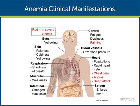 Anemia Nursing Care Management A Study Guide 57552 | Hot Sex Picture