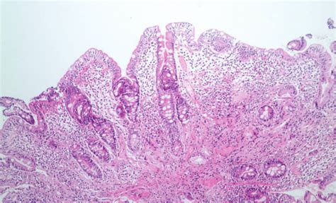 Diffuse Atrophy And Loss Of Villi Duodenal Mucosa Download