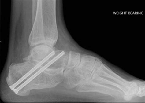 Arthroscopic Subtalar Double And Triple Fusion Foot And Ankle Clinics