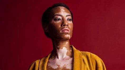 vitiligo  bercak putih  kulit kenali penyebab  pengobatannya