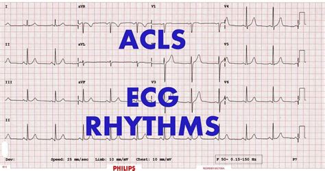 Acls Rhythm Identification Cheat Sheet